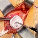 4DDOME® right indirect inguinal hernia repair