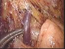 Laparoscopy-assisted distal gastrectomy with D2 lymph node dissection and uncut Roux-en-Y reconstruction