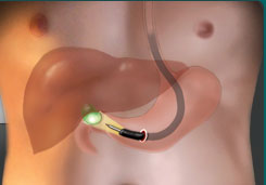 Natural Orifice Transluminal Endoscopic Surgery (NOTES)