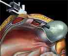 The insufflator in laparoscopy